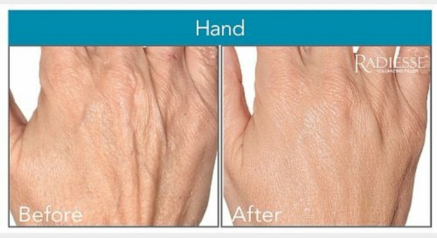 How to Rejuvenate Your Hands | Washingtonian Plastic Surgery