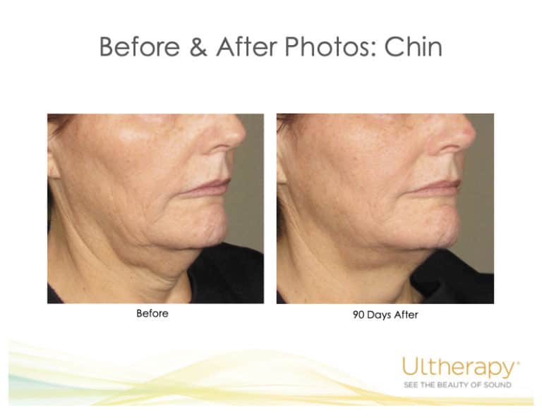 Ultherapy Skin Lifting Plastic Surgery Reston McLean VA Med Spa