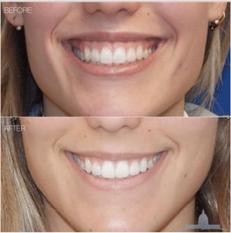 Before and after comparison of a smile showing lip improvements.